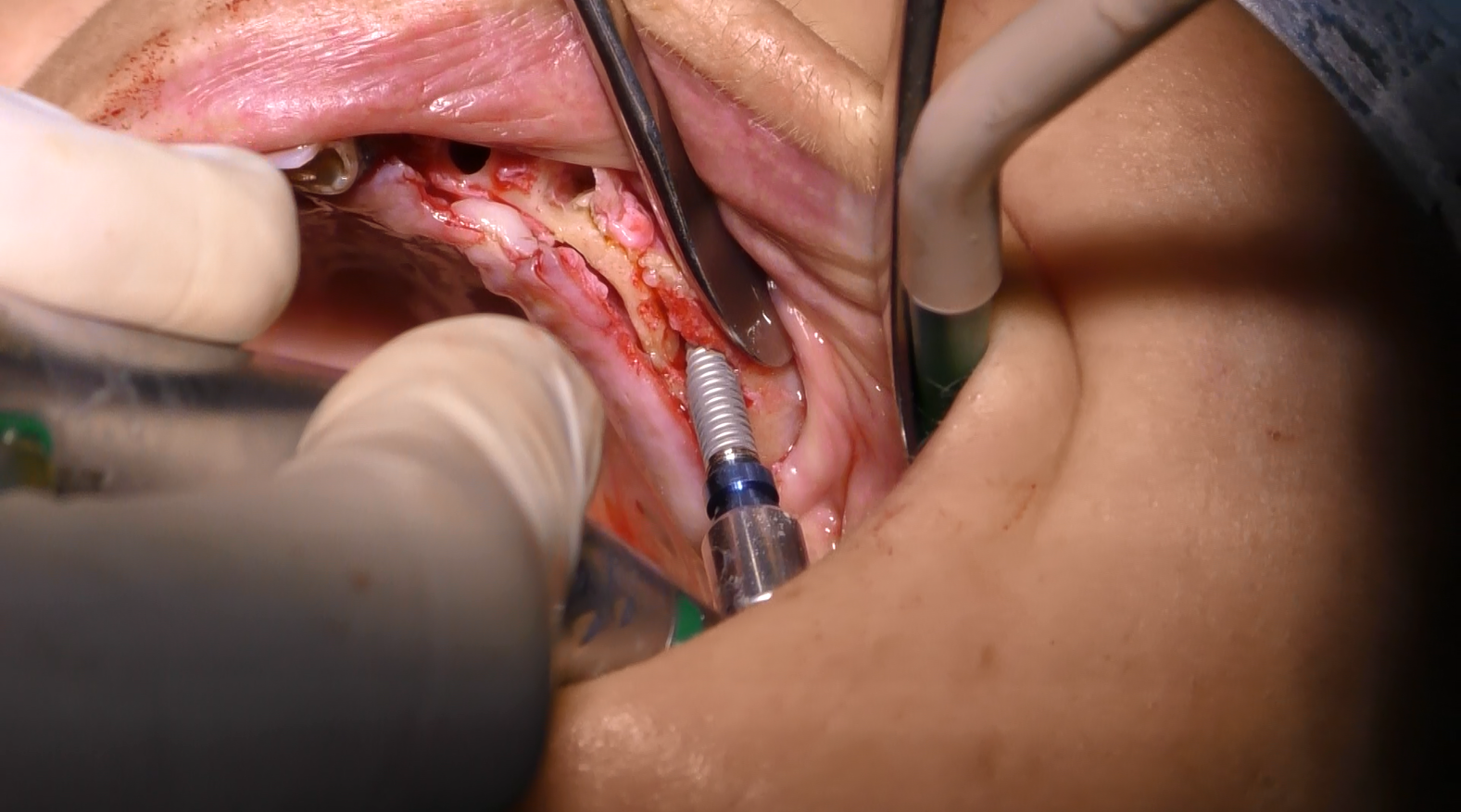 Implantologia poco osso (Denti Fissi a carico immediato)