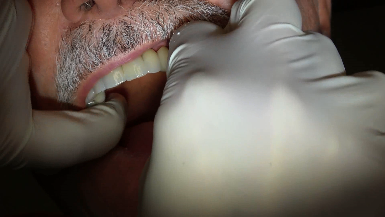 Impianti dentali senza osso evita innesti e rialzi con protesi circolare senza gengiva con Galileus Cerclage Sinus®