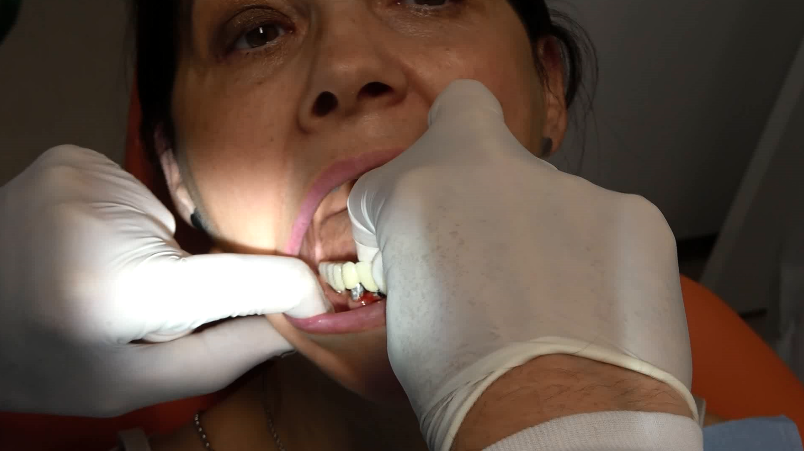 Devi fare l’implantologia dentale? Hai poco osso? Non sai come procedere? Soluzioni Indicative